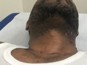ingrown hair scars on vag